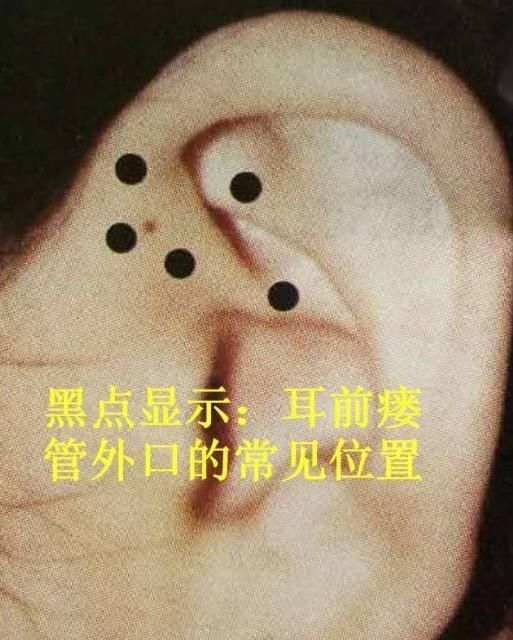 小孩耳朵恶臭,却是这个小洞搞得鬼,宝妈一定要留意!