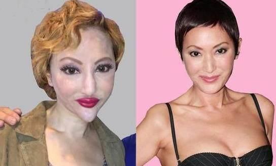 18岁女明星因长得丑整容,鼻子3个月就塌了,不料变得更