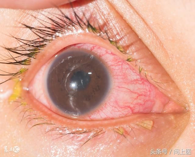眼部疾病是类风湿性关节炎的征兆吗?它们有什么关系?