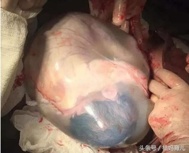 23岁孕妈剖腹生下8斤"大肉球",丈夫崩溃,医生却笑了!