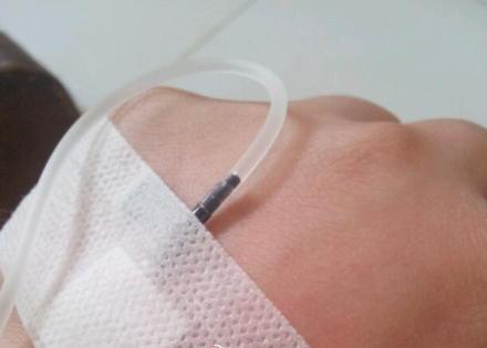 打点滴拔针肿了怎么办 你需要注意按压的时间
