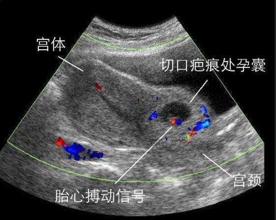 怀孕五个月的孕妇被迫引产,只因小两口在孕期做了这件