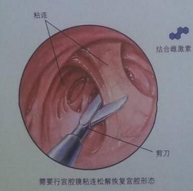 子宫的"照妖镜"解密宫腔镜