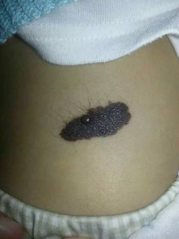 如何消除影响宝宝颜值的胎记?