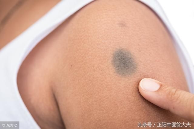 发生在掌跖,腰周,腋窝,腹股沟等易摩擦部位的交界痣,混合痣,出现以下