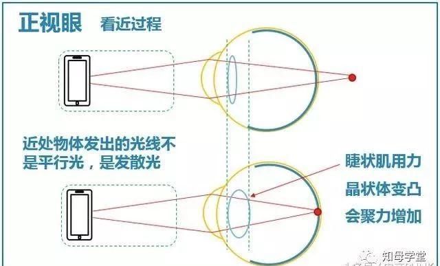 近视,据说老了可以不戴老花镜?