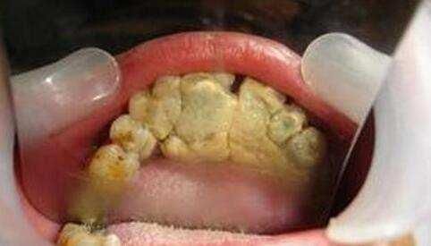 牙结石堆积在牙齿与牙龈边缘及牙缝中,长期如此会刺激牙龈,导致牙龈
