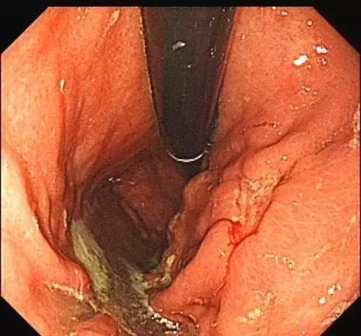 胃粘膜-早期胃癌