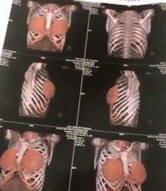 最后医生给女子做了彩色胸透,发现女孩之前做过整容手术,医生怀疑是