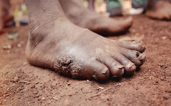 沙蚤病在非洲人身上泛滥