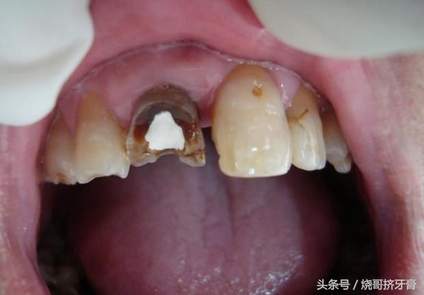 怎么判断牙髓坏死?