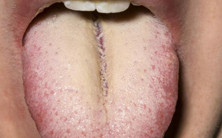 消化道功能紊乱是导致舌苔发黄的主要原因,一般是患上结肠炎,消化
