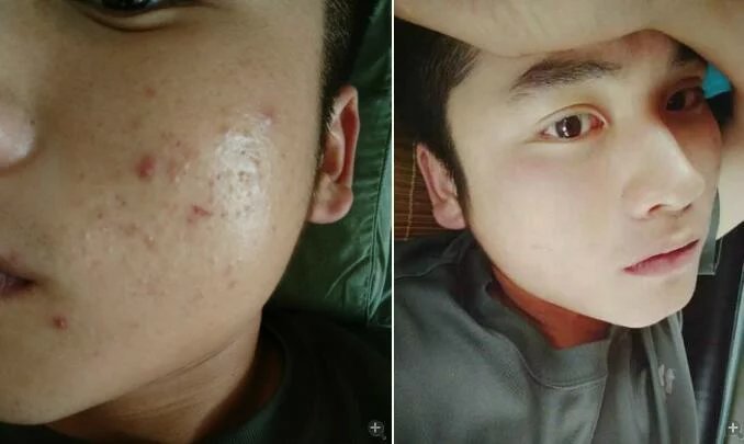 男生脸上长浓包痘痘怎么治?强烈推荐有效祛痘和痘印的