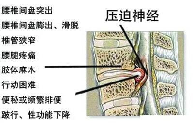 十腰九疼?一斤盐,打败专家,腰间盘突出治一个好一个!