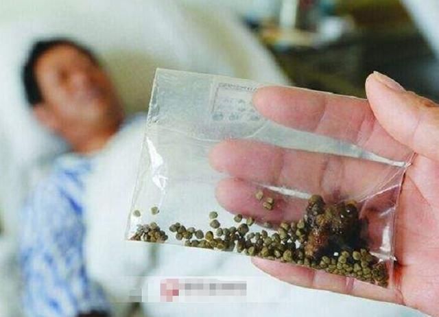 肾结石的"死对头"是它,睡前泡点喝,结石2周排干净