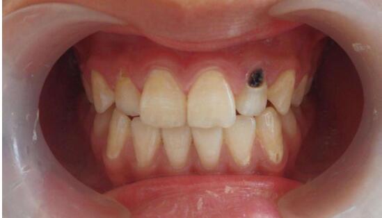 牙齿上这个小洞竟是口腔癌标志!迅速自测看你是否中招