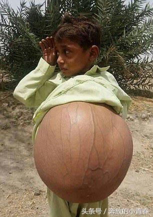 巴基斯坦9岁男孩瘦成皮包骨,肚子被粪便撑到快要爆炸