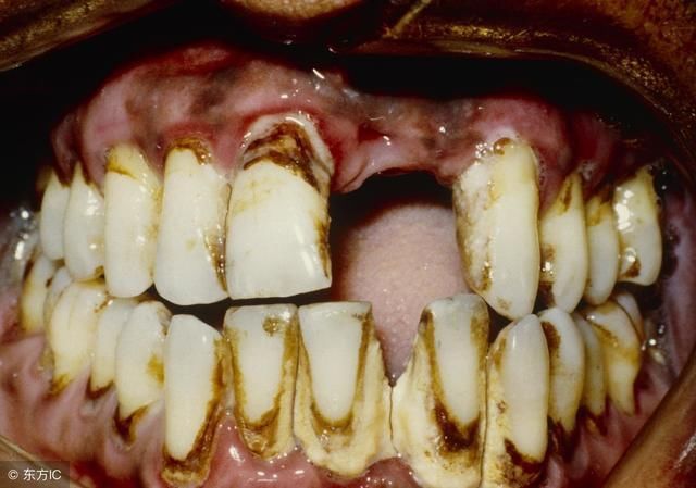 牙龈下面长出结石 难道牙齿就废了吗?