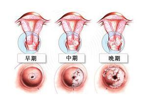 每年因各种恶性妇科导致20----30万的女性死亡,而乳腺癌,卵巢癌,宫颈