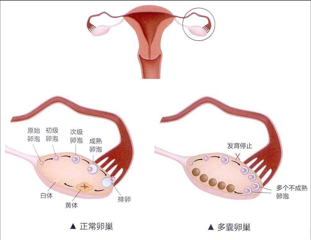 多囊卵巢试管婴儿条件是什么?