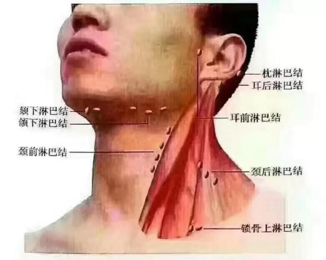 颈部浅表淋巴结更常见,其次是腋窝和腹沟.