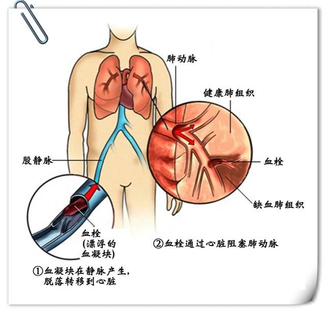 心血管病之源:房颤致血栓,后者脱落致脑梗!最后或偏瘫