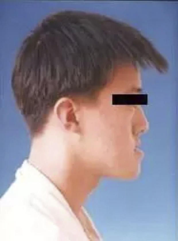 上颌前突伴下颌后缩,上颌后缩伴下颌前突,颊后缩等等,主要是骨头发育