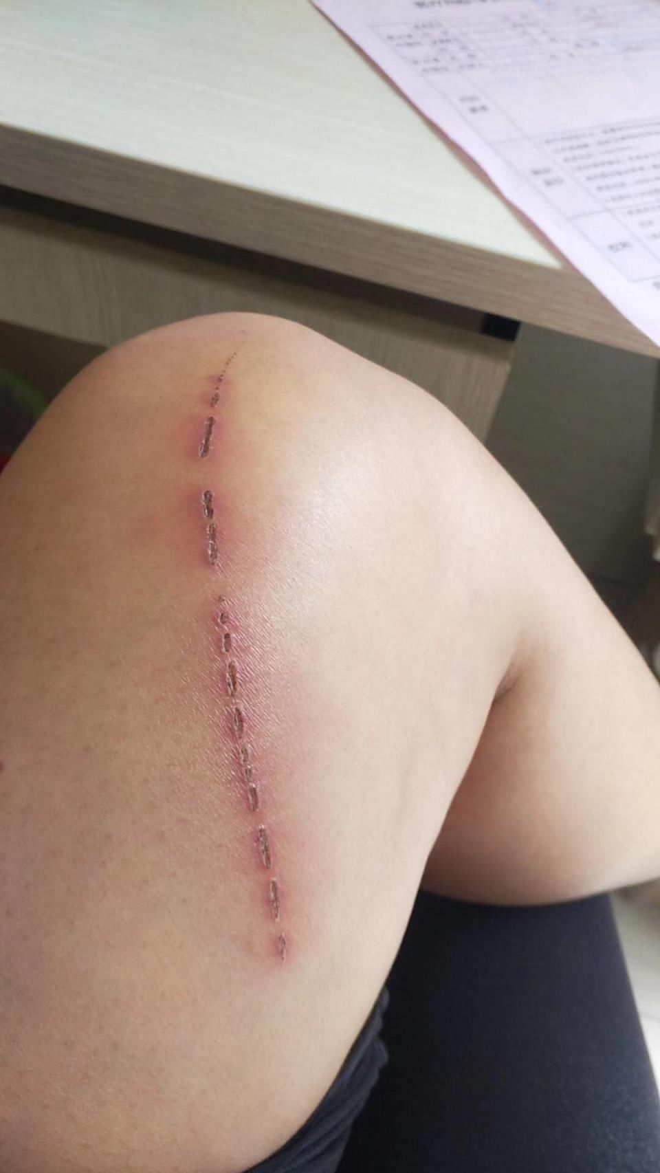 云南女孩报警:她被注射了过期的"长春长生"狂犬病疫苗
