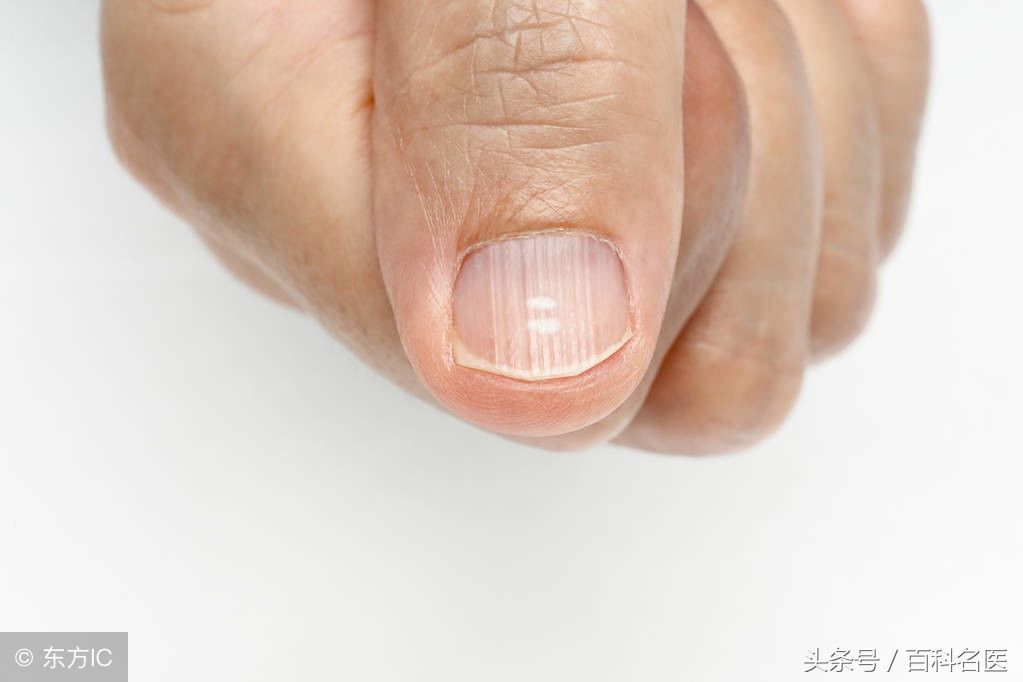 看指甲查自己的有哪些病