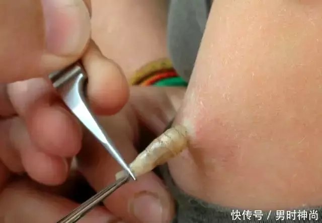 大三女生非洲旅游回来后身上竟然长了蛆虫,原因竟然是
