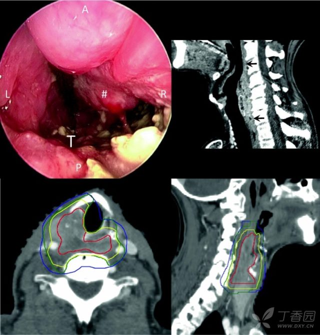 喉,下咽,口咽和口腔原发肿瘤临床靶区 (ctv-p) 勾画共识