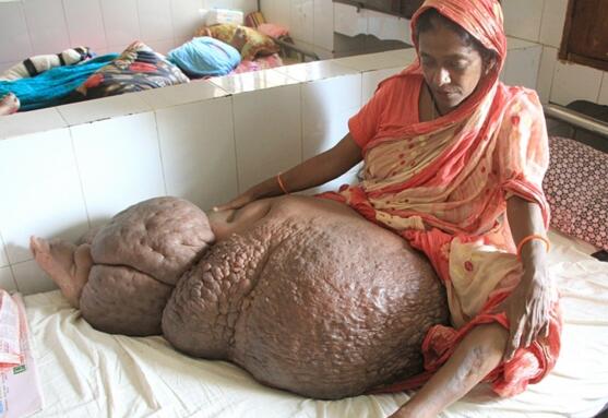 孟加拉女子腿部增生重达60公斤画面惊悚 疑患象皮病生