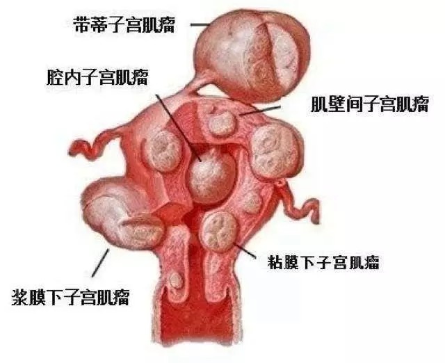 子宫肌瘤,乳腺增生,卵巢囊肿,甲状腺肿大,它的根部都在肝上