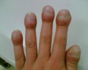 一,杵状膨大 杵状膨大医学上指人的指甲显著地向上拱起,而且围绕手指