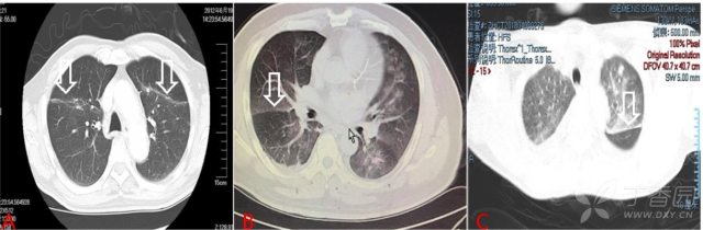 「临床上确实会碰到一些以急性呼吸困难,ct 提示肺水肿为主要表现的