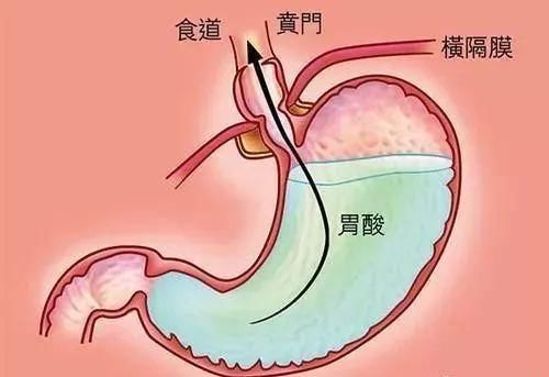 消化科医生提醒:这3个信号是胃癌,不是胃炎!早发现可保命