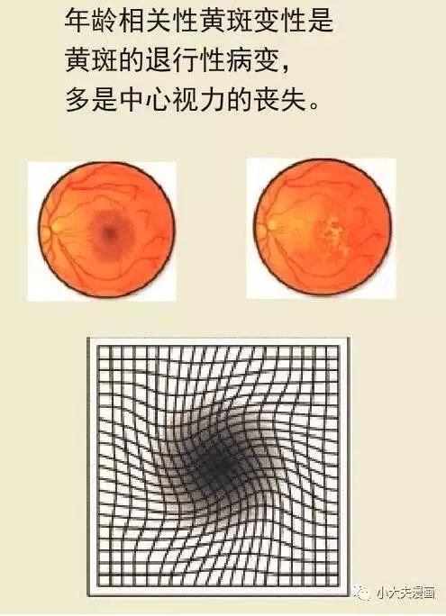 年龄相关性黄斑变性分为干性和湿性两种.