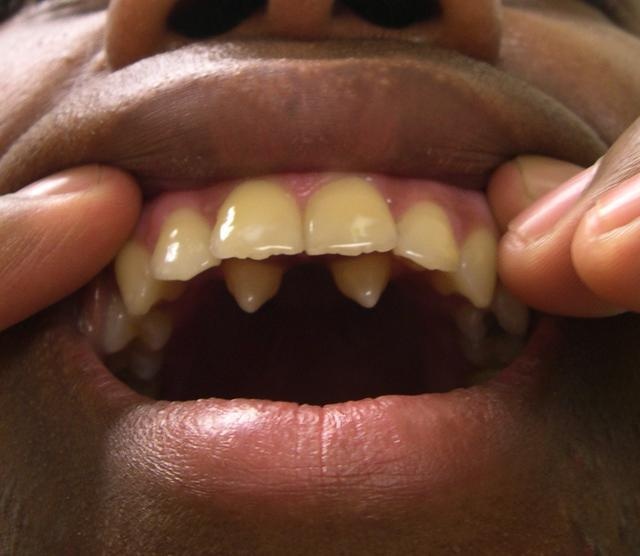 罕见多齿症患者嘴里长满牙齿,密集恐惧症的噩梦