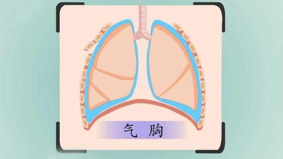 刚出生就呼吸困难?新生儿得气胸,只因肺部有个洞!