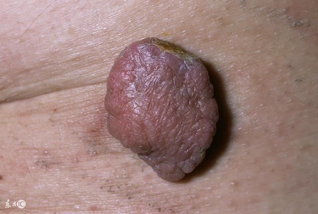 临床上,部分脂肪瘤在一些特定情况也会发生恶变形成脂肪肉瘤的可能性