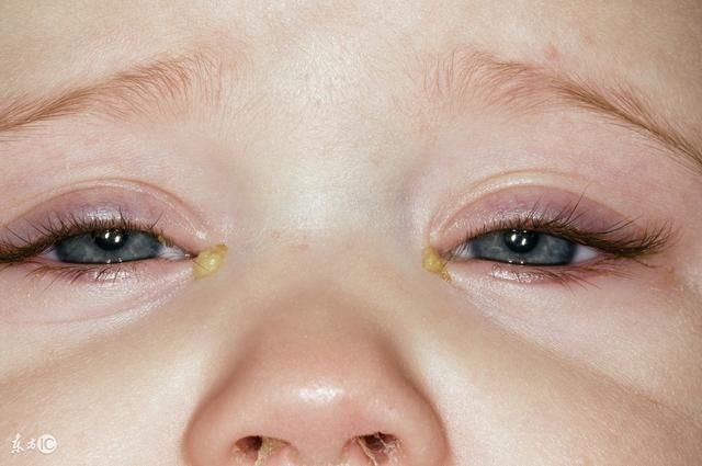4～5个月婴儿眼睛异常,最大可能是斜视和结膜炎