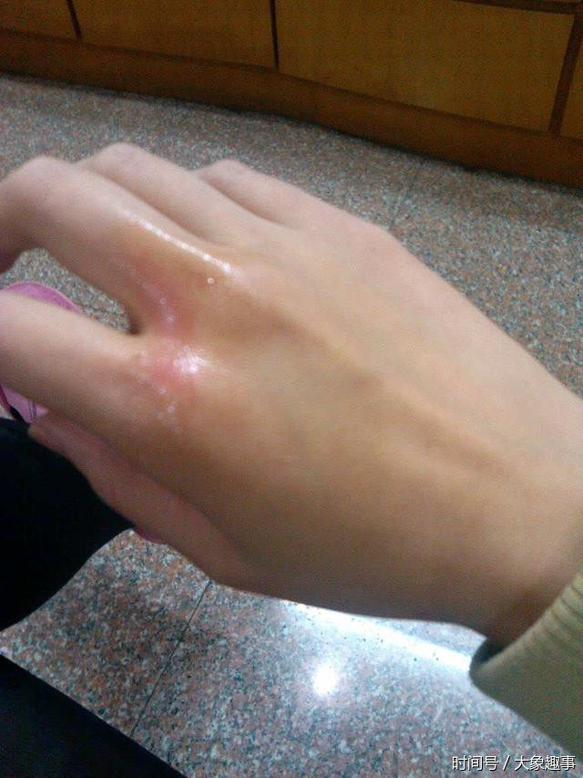 误区三:用粘性绷带包扎伤口   粘性绷带会粘住皮肤,造成进一步损伤