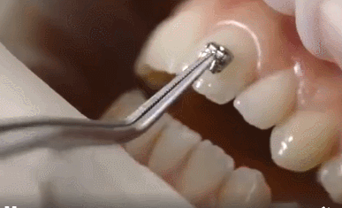 粘牙套的全过程,看看牙套是怎么粘在牙齿上的!