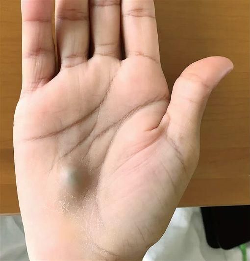 体重狂掉12kg!男子看牙后手掌冒蓝色肿块 竟是心脏出问题