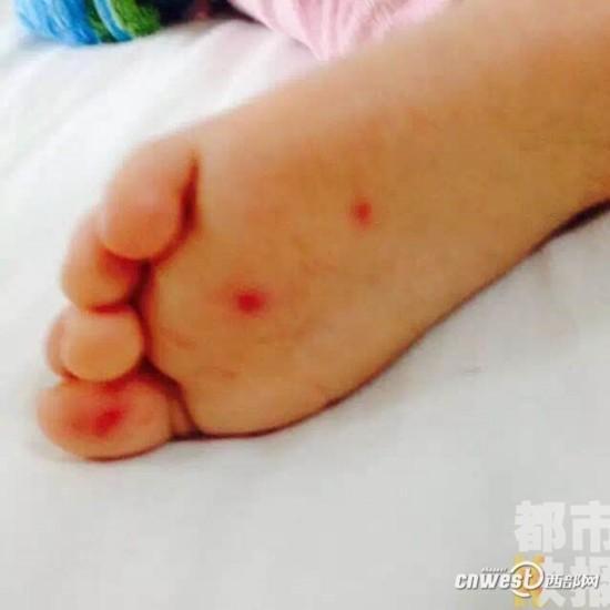 注意!孩子身上一出现小红点 可能传染手足口病