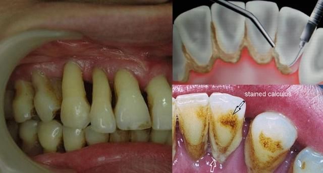 而洗牙之后,牙结石没了,患者就觉得牙齿松动.
