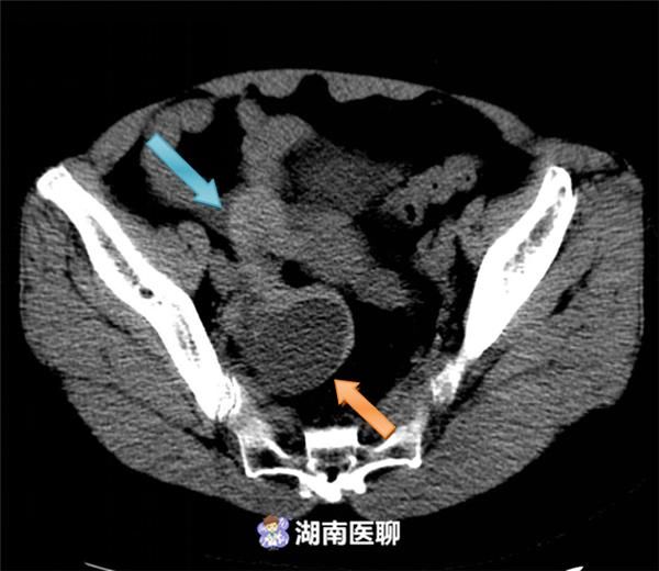 急诊彩超提示:范女士右侧附件区囊性包块并伴有盆腔积液.