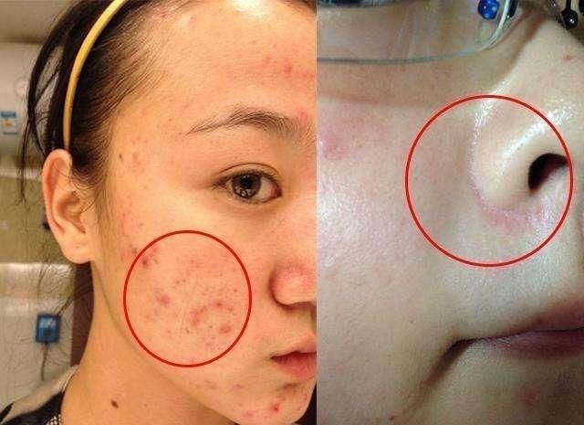 脸上长螨虫并不可怕,可怕的是你的无知 教你如何清除螨虫