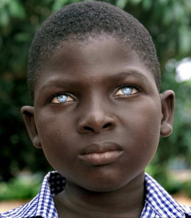 11.眼白化症.它会影响眼睛,导致色素从虹膜消失.