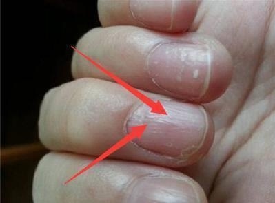 如果是手上有灰指甲,可以直接将手直接浸泡在制好的溶液当中,静置15